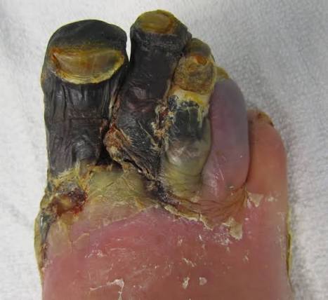 Clinical photograph of gangrenous necrosis affecting the toes