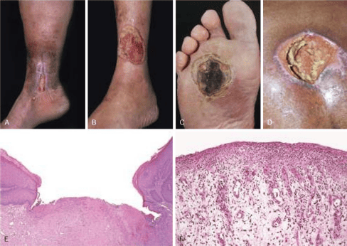Clinical photographs and histology of venous, arterial, diabetic, and pressure ulcers