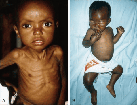 Clinical photographs contrasting a child with marasmus showing severe emaciation with an infant with kwashiorkor showing generalized pitting edema and ascites