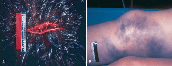 Clinical photographs contrasting a scalp laceration showing tissue bridging with a cutaneous contusion showing subcutaneous extravasation