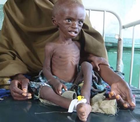 Clinical presentation of severe marasmus in a pediatric patient
