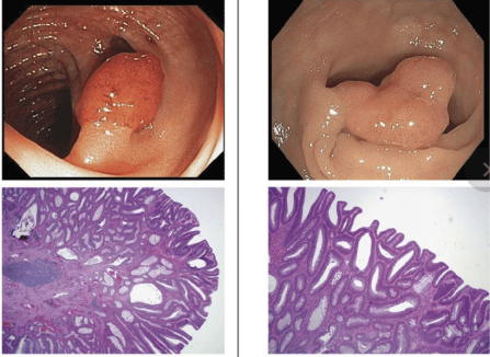 Colonic Adenoma Endoscopic and Histological Appearance