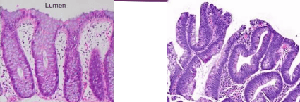 Colonic mucosa comparing healthy crypts to tubular adenoma