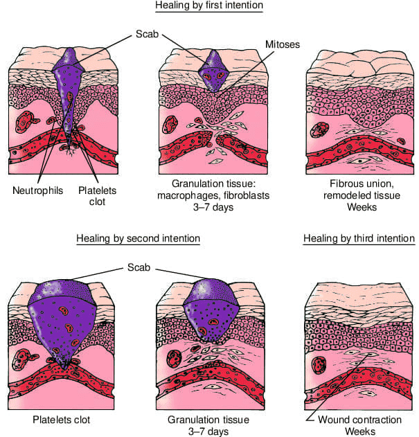 Comparative diagram of healing by first intention, second intention, and third intention