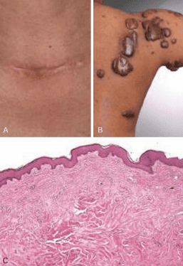 Comparison of hypertrophic scar versus keloid gross pathology and histology