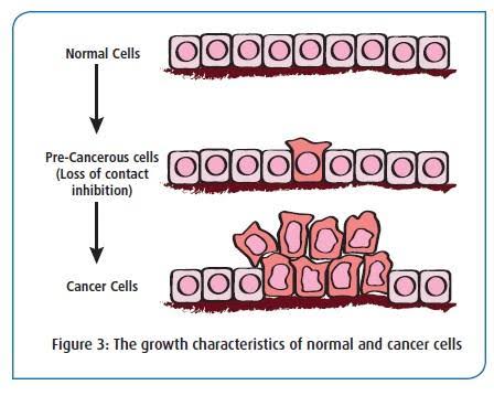 Comparison of regulated normal epithelial proliferation versus uncontrolled multilayered neoplastic growth