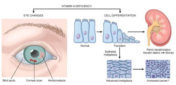 Diagram detailing ocular lesions of vitamin A deficiency alongside epithelial squamous metaplasia in the respiratory tract and kidney pelvis