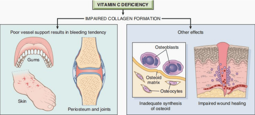 Diagram detailing the major clinical and pathological manifestations of impaired collagen synthesis in scurvy