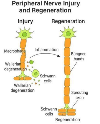 Diagram illustrating Wallerian degeneration and peripheral axonal regeneration