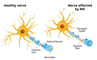 Diagram showing comparison of healthy myelinated nerve fiber versus demyelinated fiber