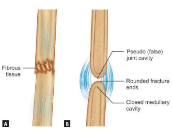 Diagram showing fibrous union and pseudoarthrosis false joint formation