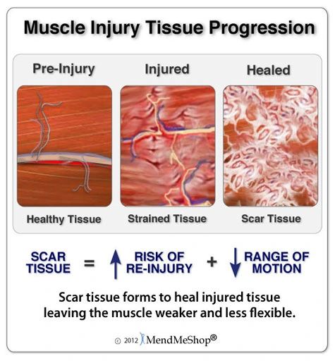 Diagram showing muscle tissue progression from pre-injury to strained tissue and scarred healed muscle