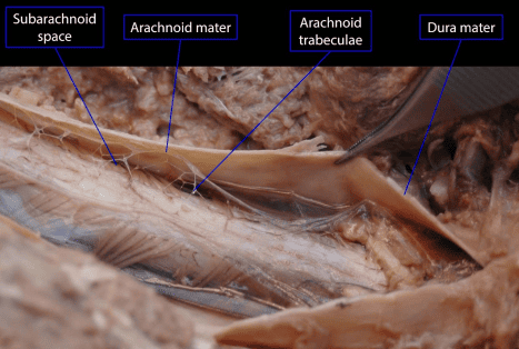 Spinal cord and meninges posterolateral dissection