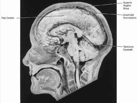 Midsagittal Brain Section Showing Dural Venous Sinuses and Arachnoid Granulations