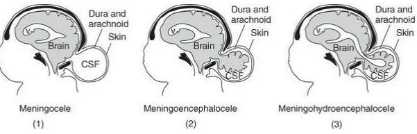 Variations of cranium bifida