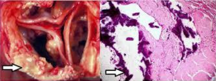 Dystrophic calcification affecting the human aortic valve gross and histology