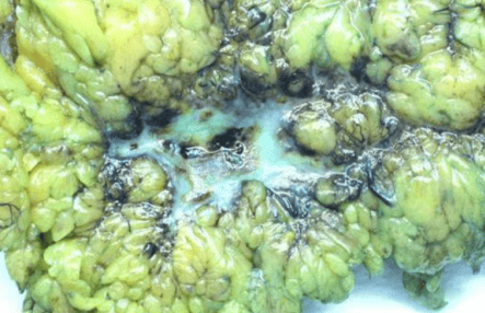 Endometrial carcinoma: transcoelomic spread