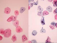 Exfoliative cervical cytology smear
