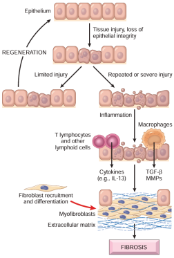 Flow diagram depicting cytokines and cell types leading to chronic tissue fibrosis