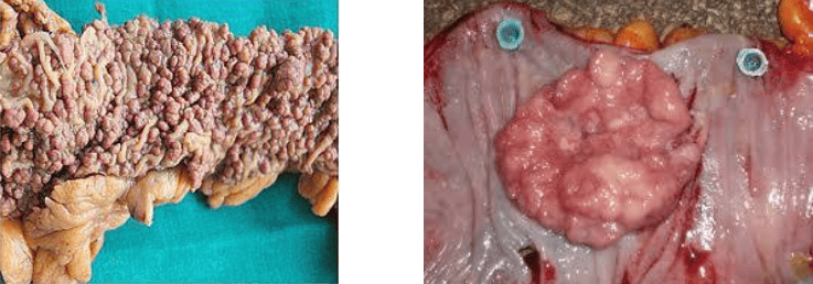 Gross Morphology of Familial Adenomatous Polyposis