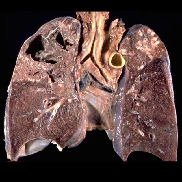 Gross anatomy coronal slice of lung with cavitary tuberculosis