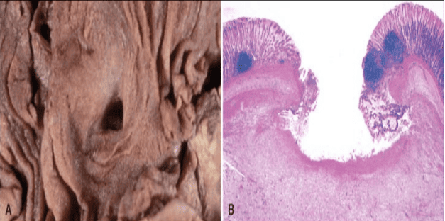 Gross and Microscopic Anatomy of an Ulcer