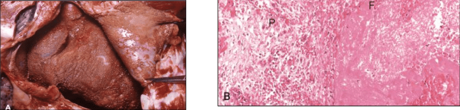 Gross and Microscopic Fibrinous Pericarditis
