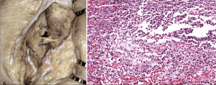 Gross and Microscopic Purulent Exudate