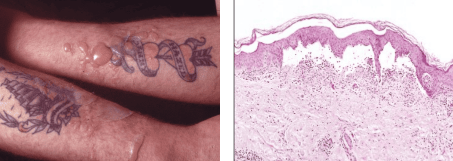 Gross and Microscopic Serous Burn Blisters
