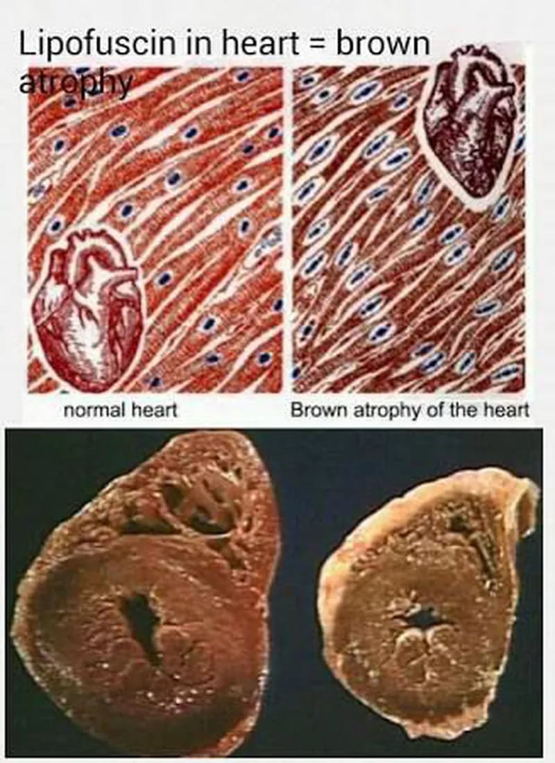 Gross and microscopic features of cardiac brown atrophy