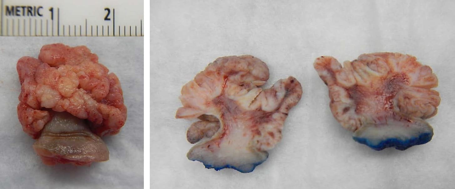 Gross appearance of squamous cell papilloma