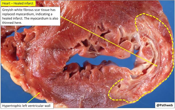 Gross bisection of infarcted and healed myocardium