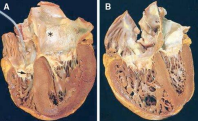Gross cardiac pathology: concentric left ventricular hypertrophy