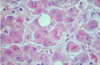 Gross liver steatosis compared to histology with macrovesicular lipid vacuoles
