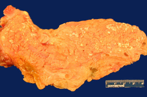 Gross pathology of pancreatic enzymatic fat necrosis