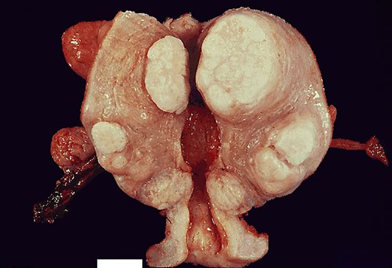 Gross pathology of uterine leiomyomas