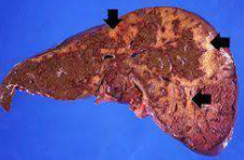 Gross specimen of cirrhotic liver