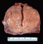 Gross surgical pathology specimen with measurement scale