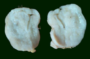 Gross tissue resection showing circumscribed lesion