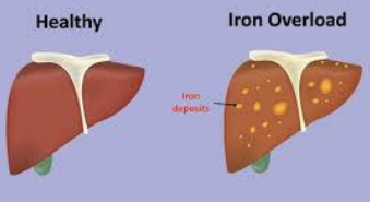 Hepatic Iron Overload in Hemochromatosis