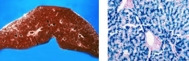 Hepatic hemochromatosis showing gross chocolate-brown appearance and Prussian blue staining