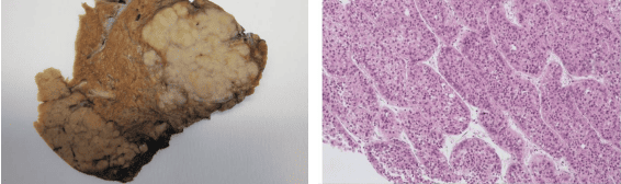 Hepatocellular carcinoma Gross and Microscopic
