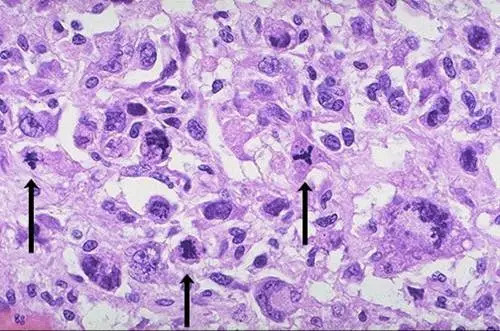 High power microscopic view of anaplastic tumor cells