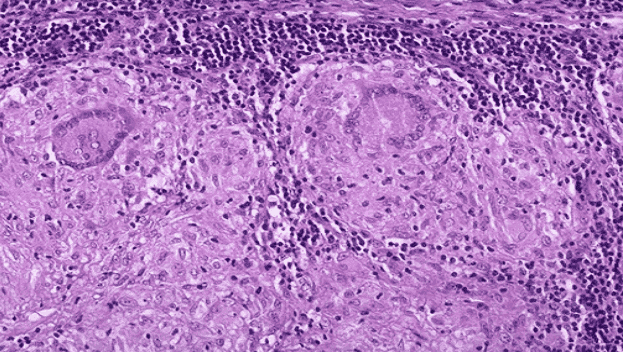 High-power view of cohesive epithelioid histiocytes and multinucleated giant cells