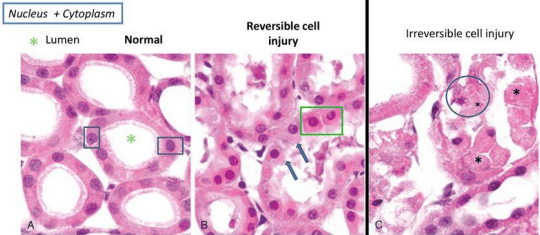 Microscopic histology of renal tubular epithelium comparing normal, reversible injury, and necrosis
