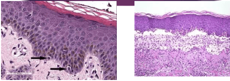 Histological comparison of healthy epidermis and bullous pemphigoid