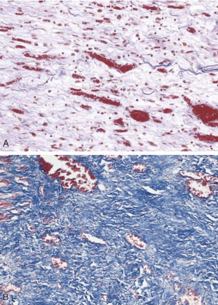 Histological comparison of vascular granulation tissue versus dense fibrous scar