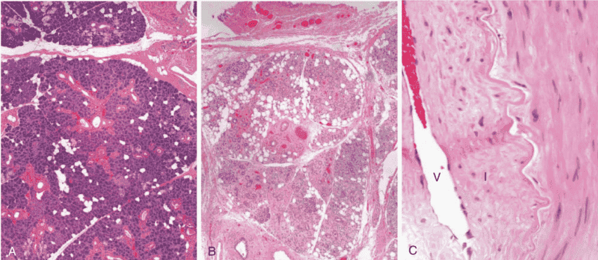 Histological sections showing normal salivary gland versus post-radiation fibrosis and fibrointimal vascular sclerosis