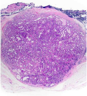 Histopathologic section showing follicular and cellular proliferation