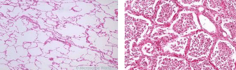Histopathology of normal pulmonary alveoli versus acute bacterial pneumonia